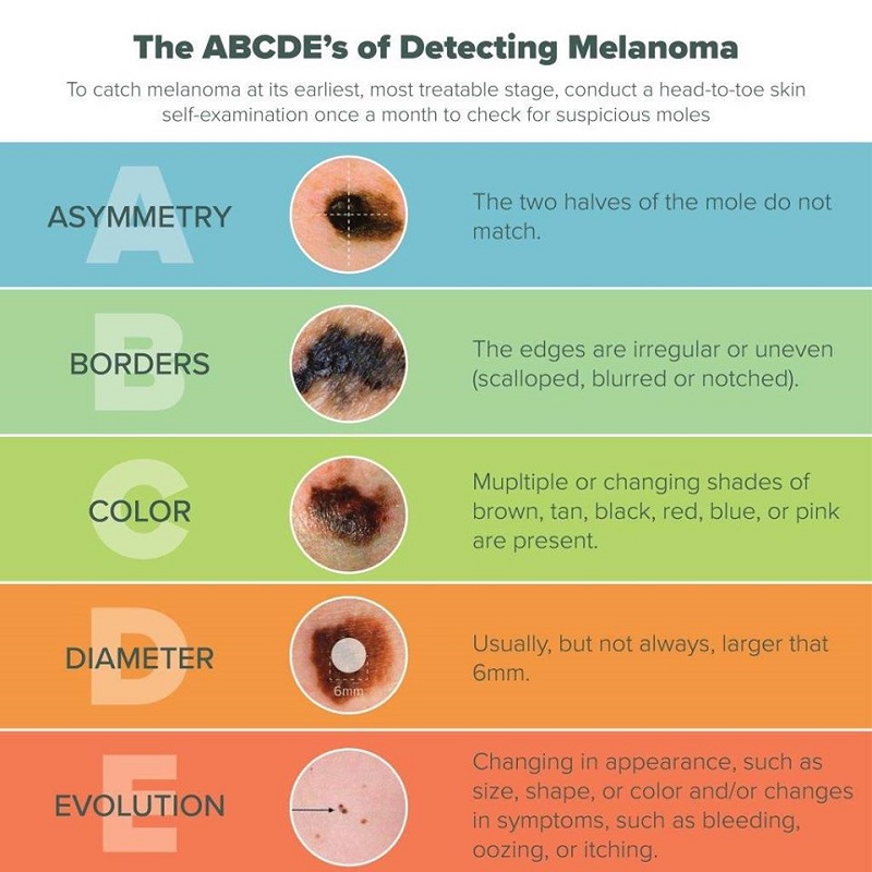 Chẩn đoán ung thư thông qua nốt ruồi sẽ được thực hiện bằng cách kiểm tra ABCDE